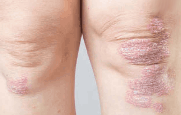  آرتروز پسوریاتیک