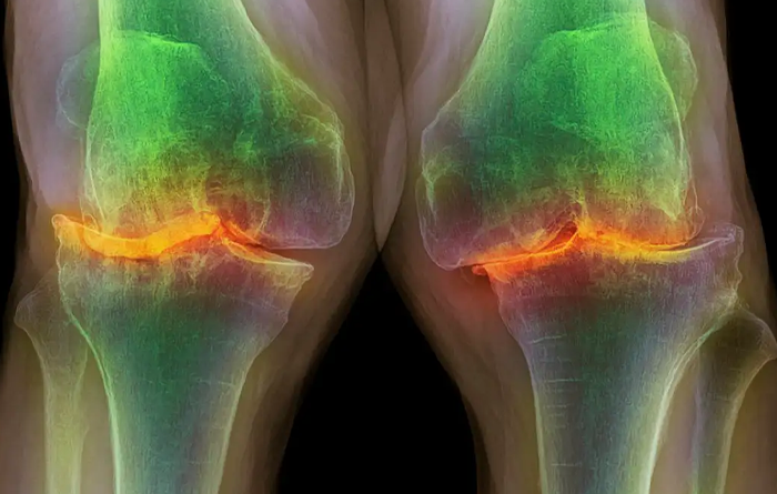 چه افرادی بیشتر در معرض آرتروز زانو قرار دارند؟