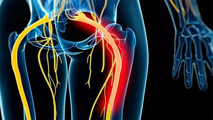 علائم آسیب به عصب سیاتیک