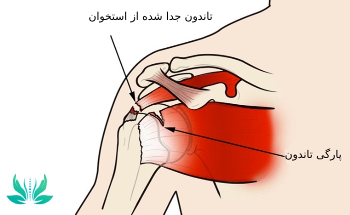 آسیب‌ تاندون چیست و چگونه اتفاق می‌افتد؟