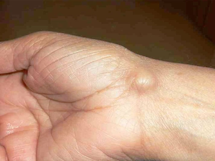 عود مجدد تومور ژانت سل و عوارض آن