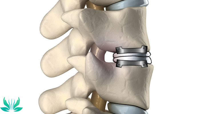 جراحی دیسک گردن توسط متخصص