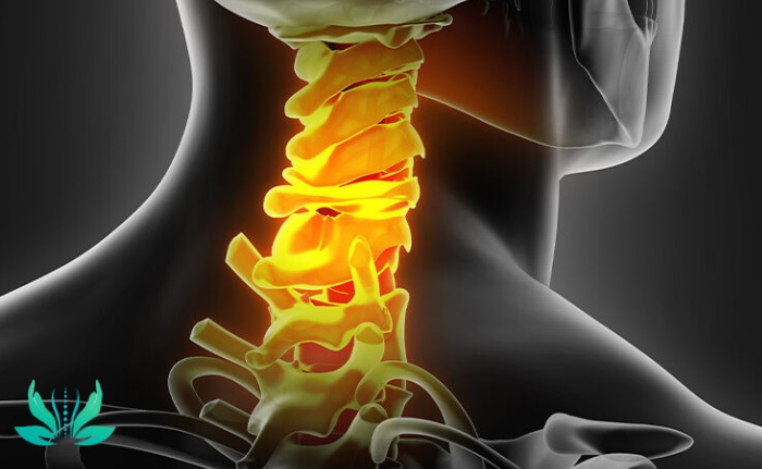 علائم دیسک گردن