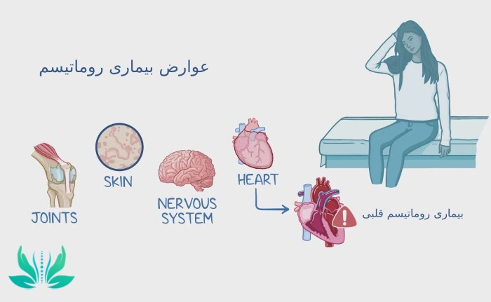 عوارض احتمالی بیماری‌های روماتیسمی