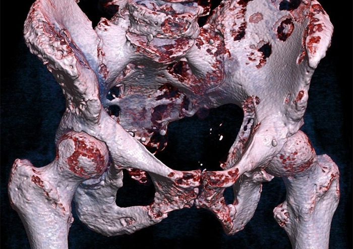 انواع تومورهای استخوانی در لگن