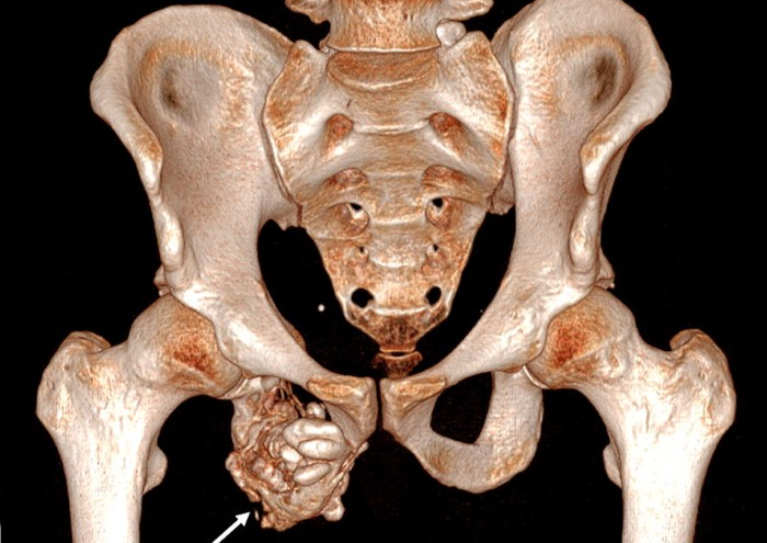 سارکوم یوئینگ