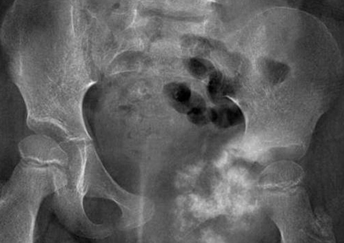 چه عواملی باعث ایجاد سرطان استخوان لگن میشوند؟