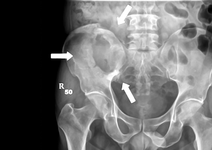 علائم سرطان لگن استخوانی
