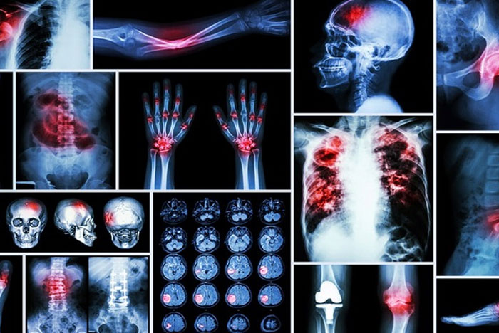 سرطان استخوان چیست 