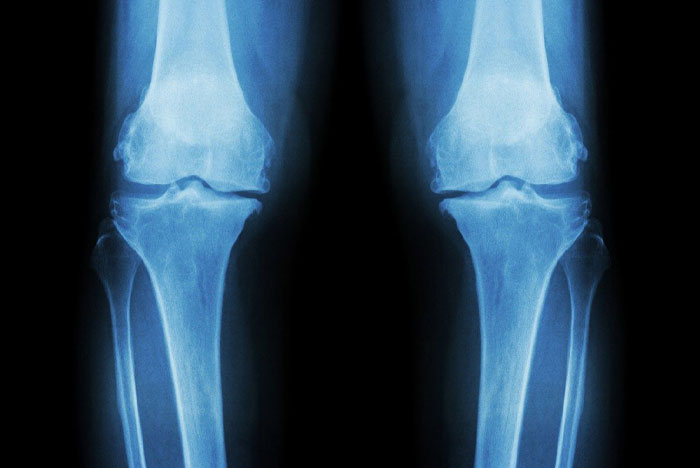 درجه‌بندی سرطان استخوان