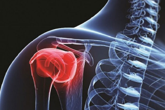 استئوسارکوم