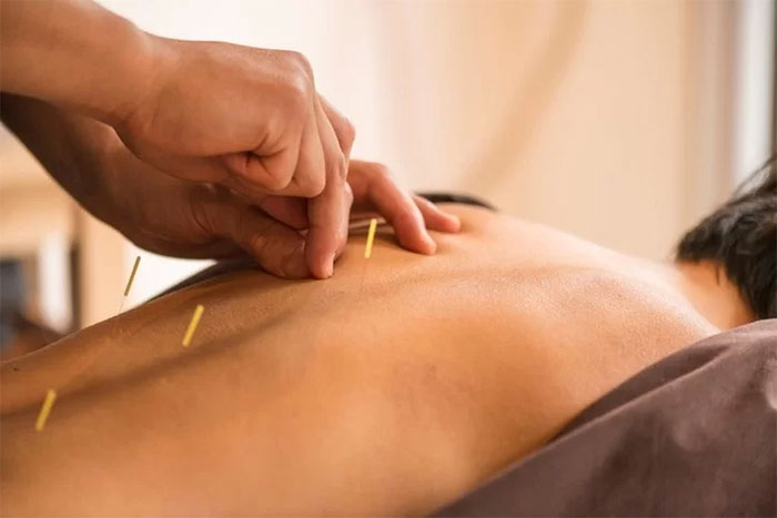 طب سوزنی چیست؟