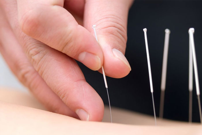 چه مراکزی خدمات طب سوزنی ارائه می‌دهند؟