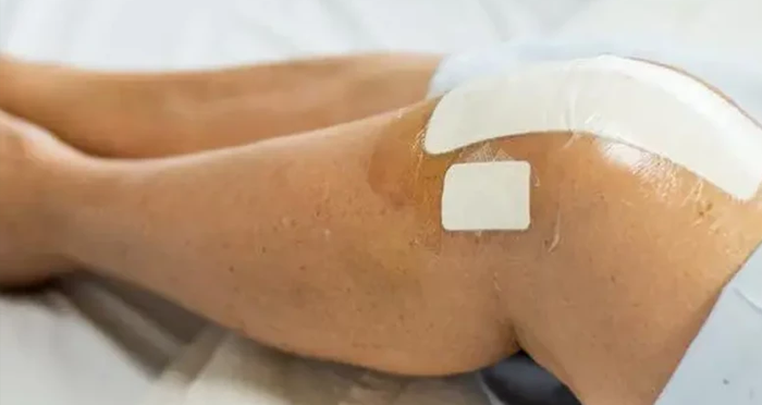 مراقبت های بعد از تعویض مفصل زانو