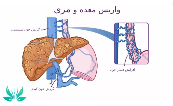 واریس مری