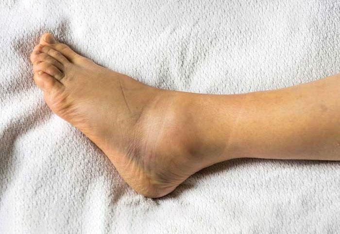 نشانه‌های همراه ورم پا 