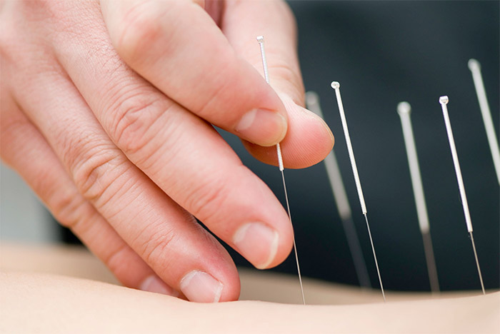 Dry Needling