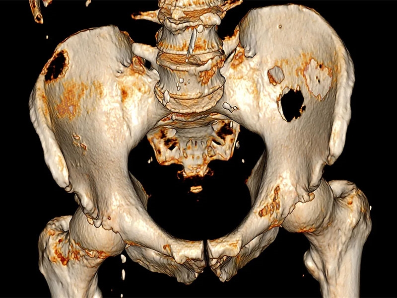 بررسی علائم و روش‌های درمان سرطان استخوان