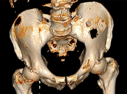 بررسی علائم و روش‌های درمان سرطان استخوان