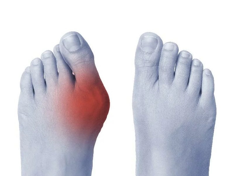 بررسی علل، علائم و روشهای درمان دررفتگی انگشتان پا