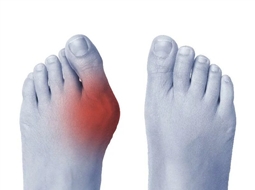 بررسی علل، علائم و روش‌های درمان دررفتگی انگشتان پا