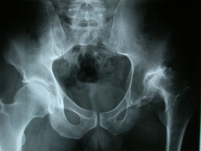 آشنایی با نشانه‌ها و درمان سرطان استخوان لگن