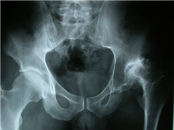 آشنایی با نشانه‌ها و درمان سرطان استخوان لگن