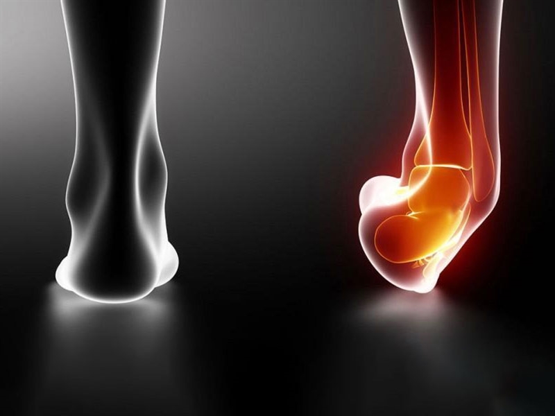 پیچ خوردگی مچ پا: از تشخیص تا بازگشت به فعالیت‌های روزمره