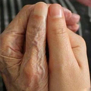  جوانسازی پوست دست و پا در کلینیک پزشک اول       